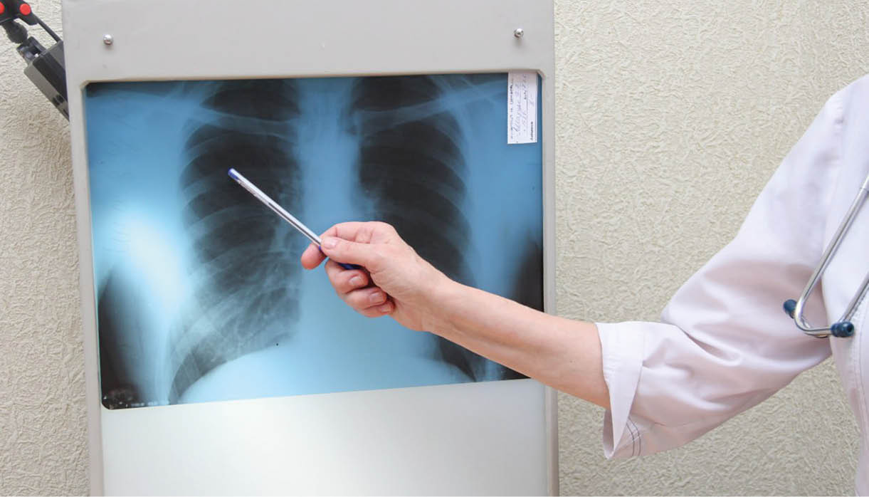 Современные методы лечения туберкулёза в Крыму и кто в зоне риска