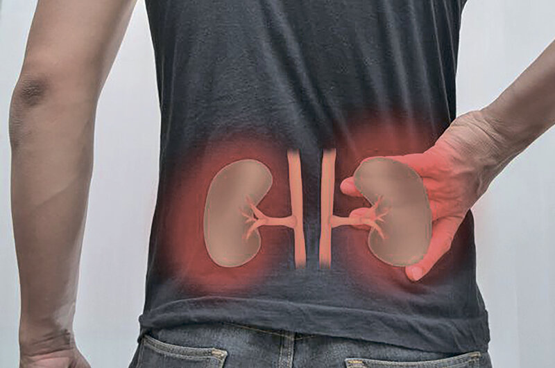 Почему курортное солнце и любовь к шашлыкам могут аукнуться мочекаменной болезнью